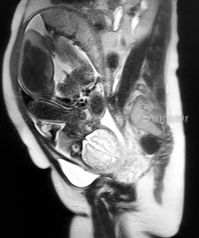 胎儿和孕妇MRI T2体重图像